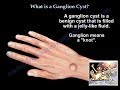 What Is A Ganglion Cyst - Everything You Need To Know - Dr. Nabil Ebraheim