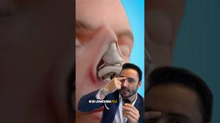 Como Se Corrige O Calombo Do Nariz Ção