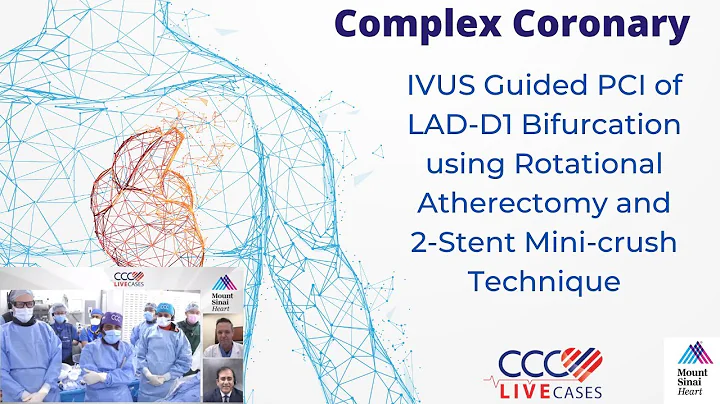 IVUS Guided PCI of LAD-D1 Bifurcation using Rotational Atherectomy and ﻿2-Stent Mini-crush Technique