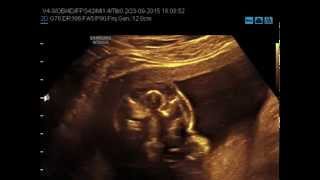 Med2000Eco Ipotelorismo Microftalmia