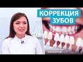 Виниры - решение эстетических проблем зубов