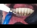 ASMR Dentist 🦷 Teeth Design and Teeth Cleaning l Dentist Cleans Your Teeth!!