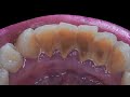 25 yo. Female&#39;s Teeth | Pembersihan Karang Gigi | Dentist | Dokter Gigi Tri Putra