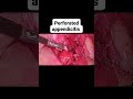 :Appendicular abscess and perforated appendicitis, successfully managed laparoscopically