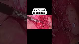 :Appendicular abscess and perforated appendicitis, successfully managed laparoscopically