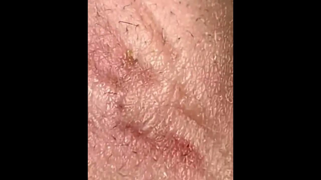 slow-motion-mouth-pops-blackheads-on-lips-satisfying-pimple-pop