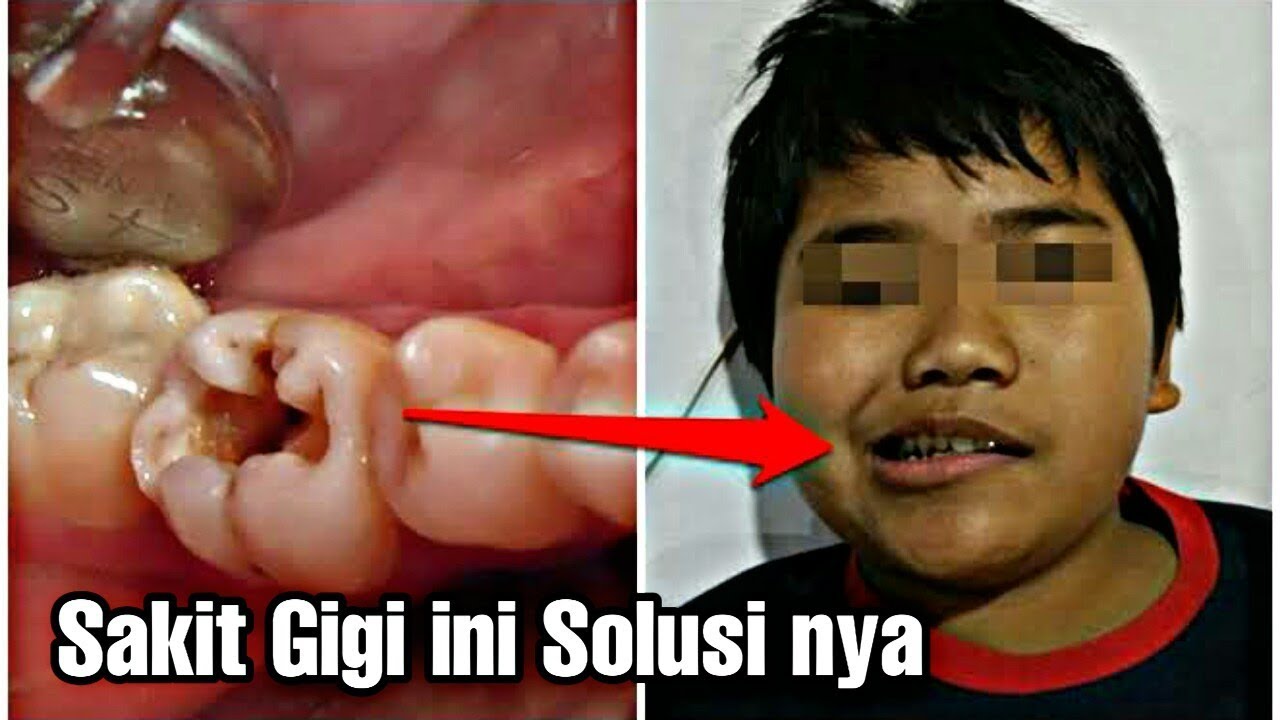 Resep herbal Mengobati Sakit Gigi 
