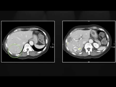 Hepatic Infections | Interesting Radiology Cases