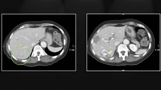 Hepatic Infections | Interesting Radiology Cases