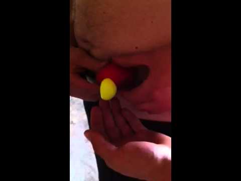 Worlds biggest zit pop leads to death - YouTube