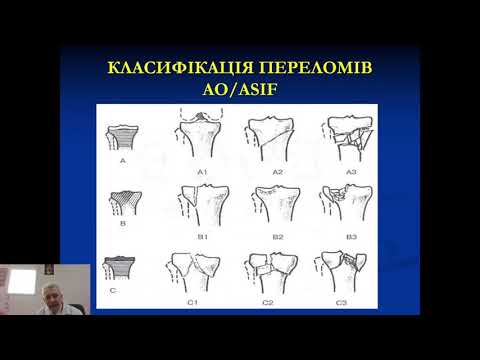 Переломи проксимального відділу великогомілкової кістки (сучасна  діагностика та лікування).