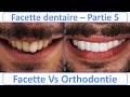 Facette dentaire vs orthodontie  guide complet  partie 5