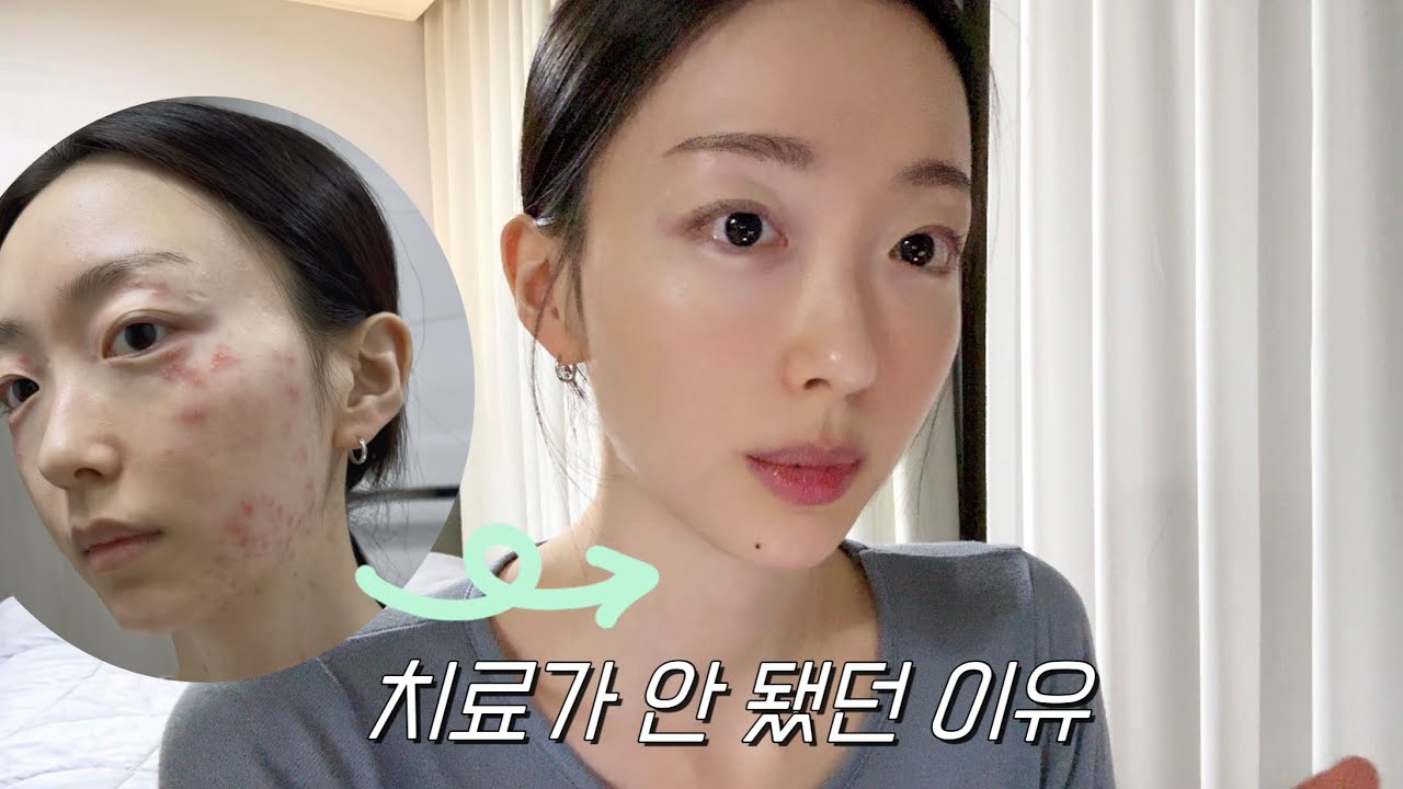 주사? 모낭염? 원인이 따로 있었습니다