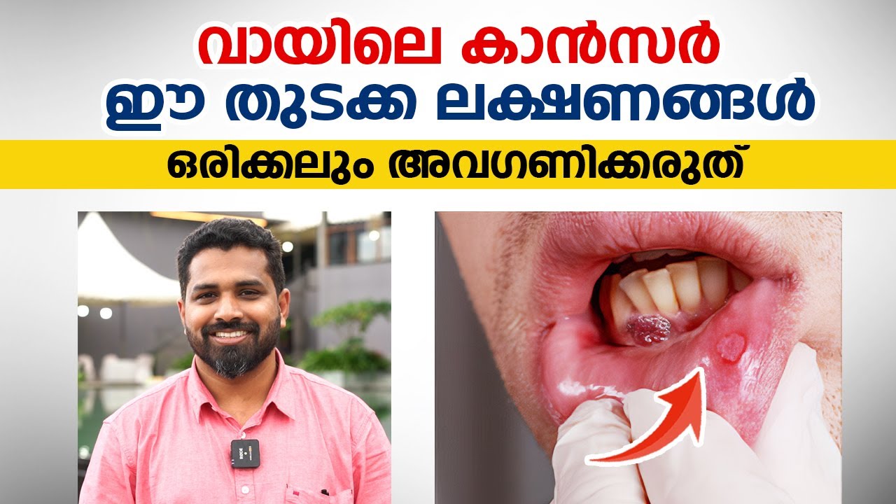 വായിലെ കാൻസർ ഈ തുടക്ക ലക്ഷണങ്ങൾ ഒരിക്കലും അവഗണിക്കരുത് | Oral cancer | arogyam