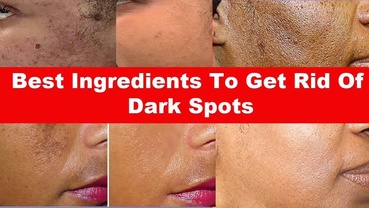 How To Get Rid Of Dark Spots Fast +  Best  Ingredients To Use
