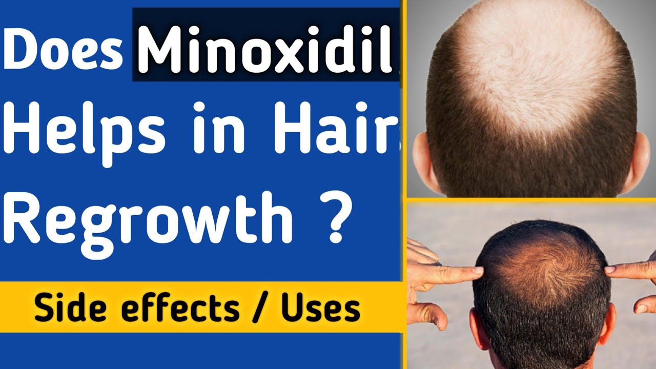 Results and Side Effects Does minoxidil help Hair regrowth | #minoxidil | #hair loss - YouTube