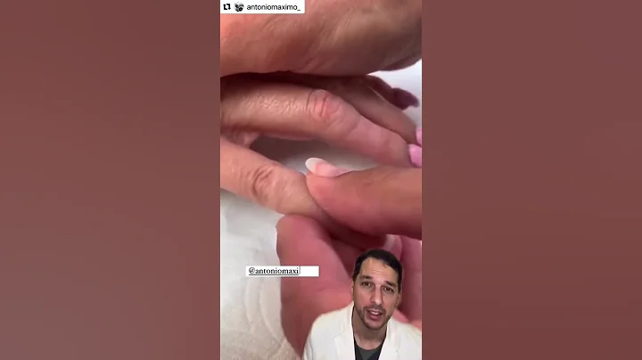 Amazing prosthetic work!#Prosthetic #Finger #Nurse #Dr #Amputation #Artist #Art #Education #Medical