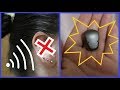 My Bone Anchored Hearing Aid (BAHA) Experience | TOASP