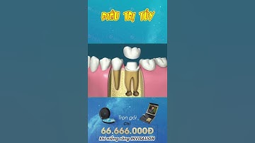 [3D] TRÁM RĂNG || Nha Khoa Quốc Tế Athena