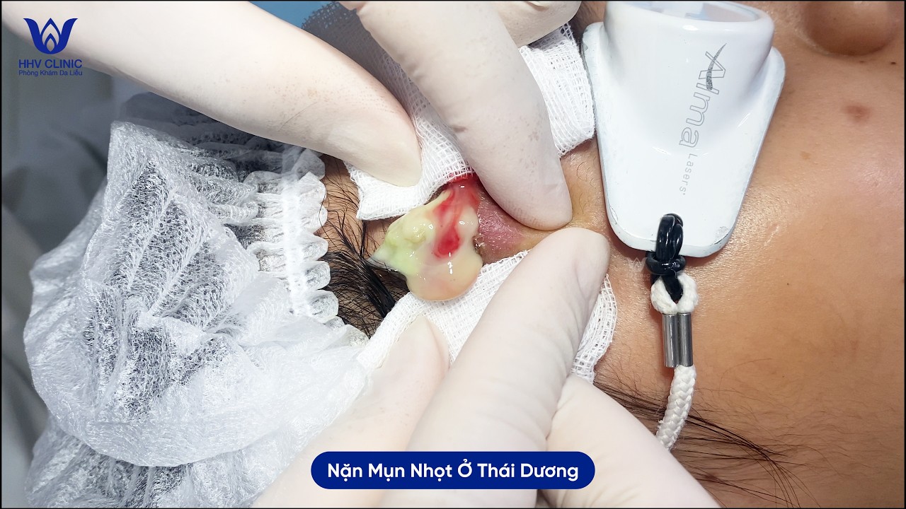 Nặn mụn nhọt sưng viêm mủ ở vùng thái dương - Tại phòng khám da liễu HHV Clinic.