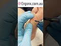Bye Bye Corns: Top Podiatrist's Expert Removal Techniques #Podiatry #FootCare