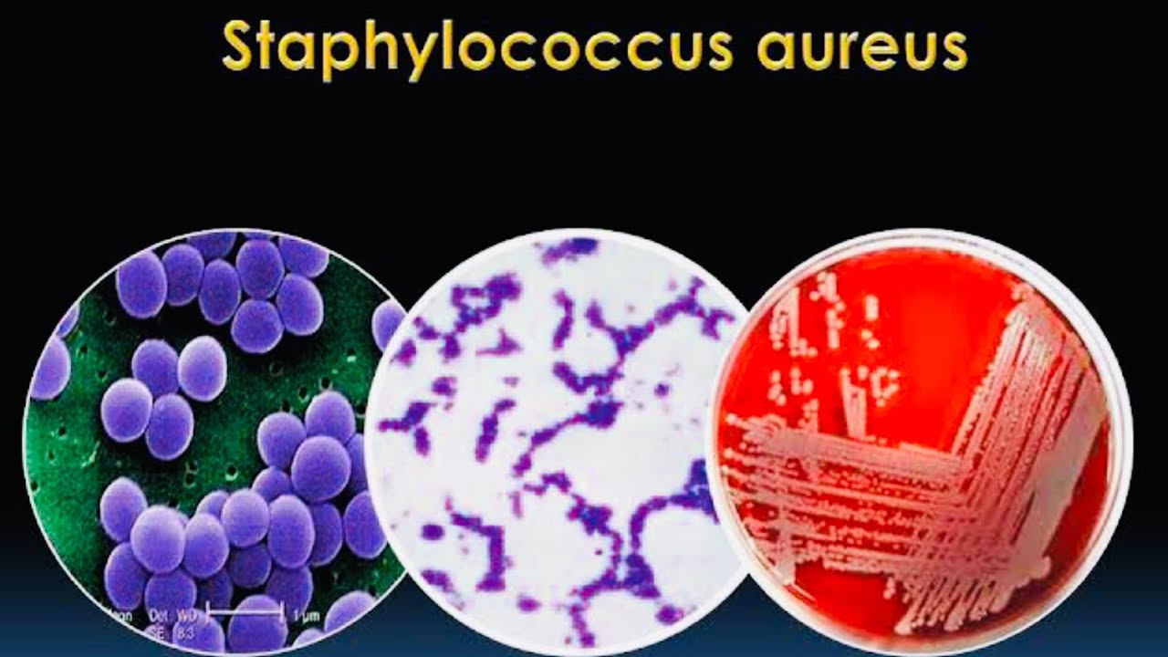 1 staphylococcus aureus. S. aureus золотистый стафилококк. Сапрофитный стафилококк. Стафилококк ауреус микроскопия. Стафилококки генцианвиолет.