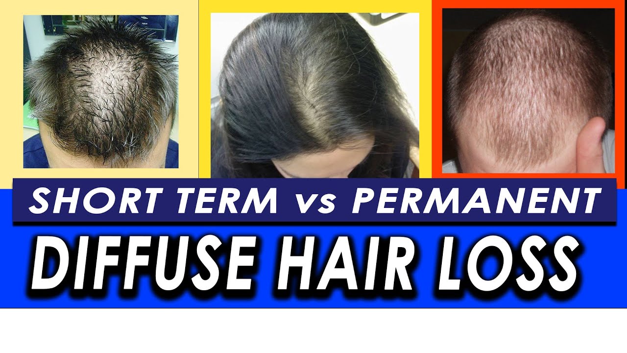 Diffuse hair loss  HairMed