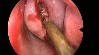 Dr. Vivek Saindran Ent Surgery Videos Pushpagiri Medical College Hospital