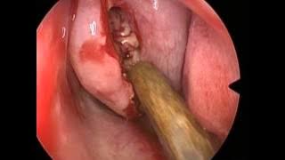 Dr. Vivek saindran ENT | Surgery Videos  | Pushpagiri Medical College Hospital