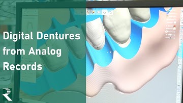 Digital Dentures from Analog Records: Digital Denture Workflow