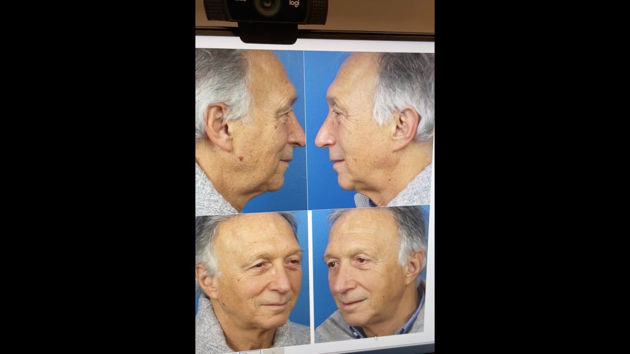 Male Facelift and Neck Lift Results Revealed Just A Few Days After Surgery