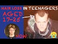 How To Stop Hair Loss In Teenagers 