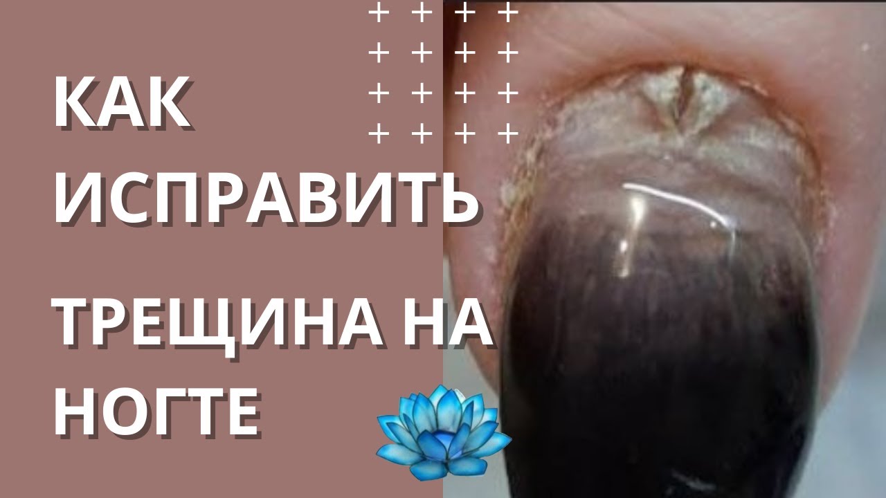 Коррекция нарощенных ногтей когда у клиента трещина на ногте.