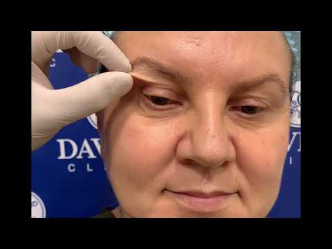 Video: Կատարե՞լ աչքի լազերային վիրահատությունից հետո: