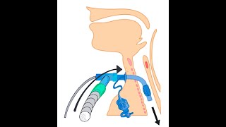 One-way speech &amp; swallow valve. How to safely use with ventilators