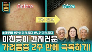 [Full] 미친듯이 간지러운 가려움증 2주 만에 극복하기! #아토피#만성가려움증#노인가려움증ㅣ귀하신 몸ㅣ52화 가려워서 미치겠어요, 가려움증