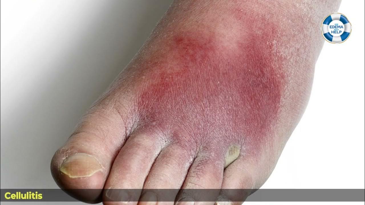 Know About Pedal Edema Causes, Symptoms & Treatment By Nephrologist Dr