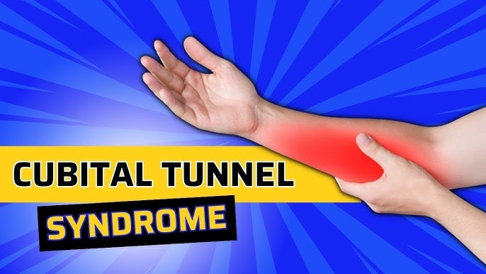Cubital Tunnel Syndrome Ulnar Nerve Entrapment - Everything You