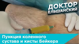 Пункция коленного сустава и кисты Бейкера