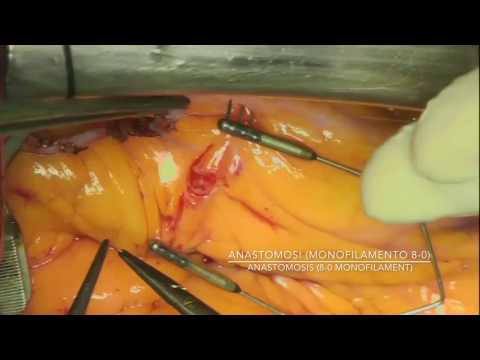 Bypass aortocoronarico