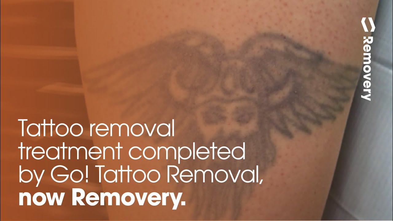 3rd laser tattoo removal treatment u0026 progress photos youtube 3rd laser tattoo removal treatment u0026 progress photos youtube