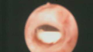 Внутриматочная спираль. Извлечение через 20 лет.(Внутриматочный контрацептив петля Липпса простояла в полости матки 20 лет. Офисная гибкая гистероскопия..., 2009-09-22T18:12:26.000Z)