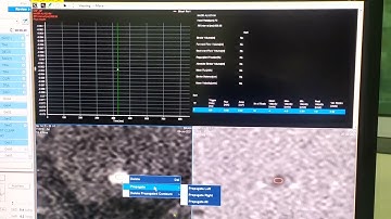 MRI CSF volume calculate || MRI Phillips |