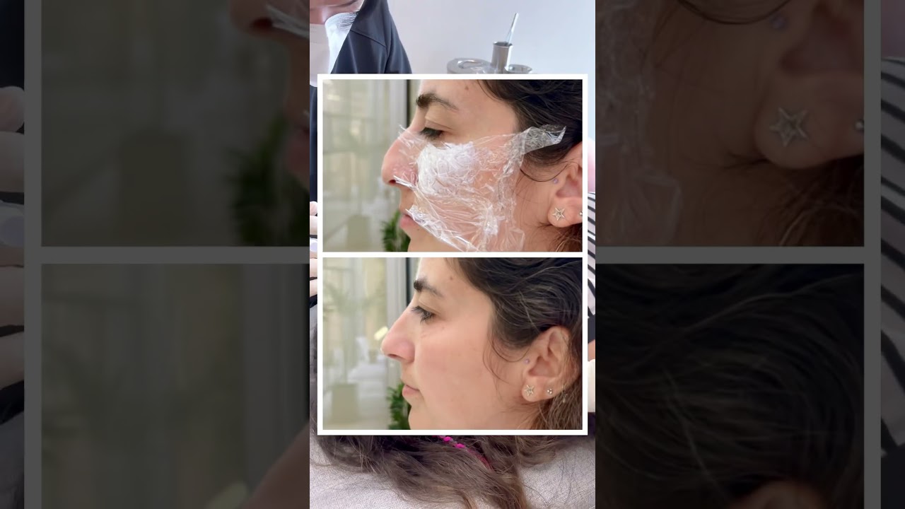 [Бьюти Блоссом Эмнэлэг] ✨ Мэс засалгүй хамар сайжруулалт ✨ #носфиллер #хамар #хувиргалт #өмнөбадараа #носжоб #шилэн арьс