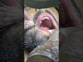 Tooth nerve pain relief 😱 #foryou #dentalclinic #shorts #fypシ゚viral