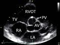 Normal echocardiography, Dr. Wael Elkilany