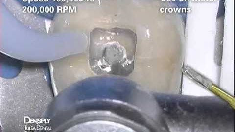 Transmetal bur clinical demonstration | Dentsply Sirona