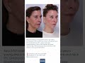 3 weeks after a NaturaLyft™ with Dr. Dilip D. Madnani