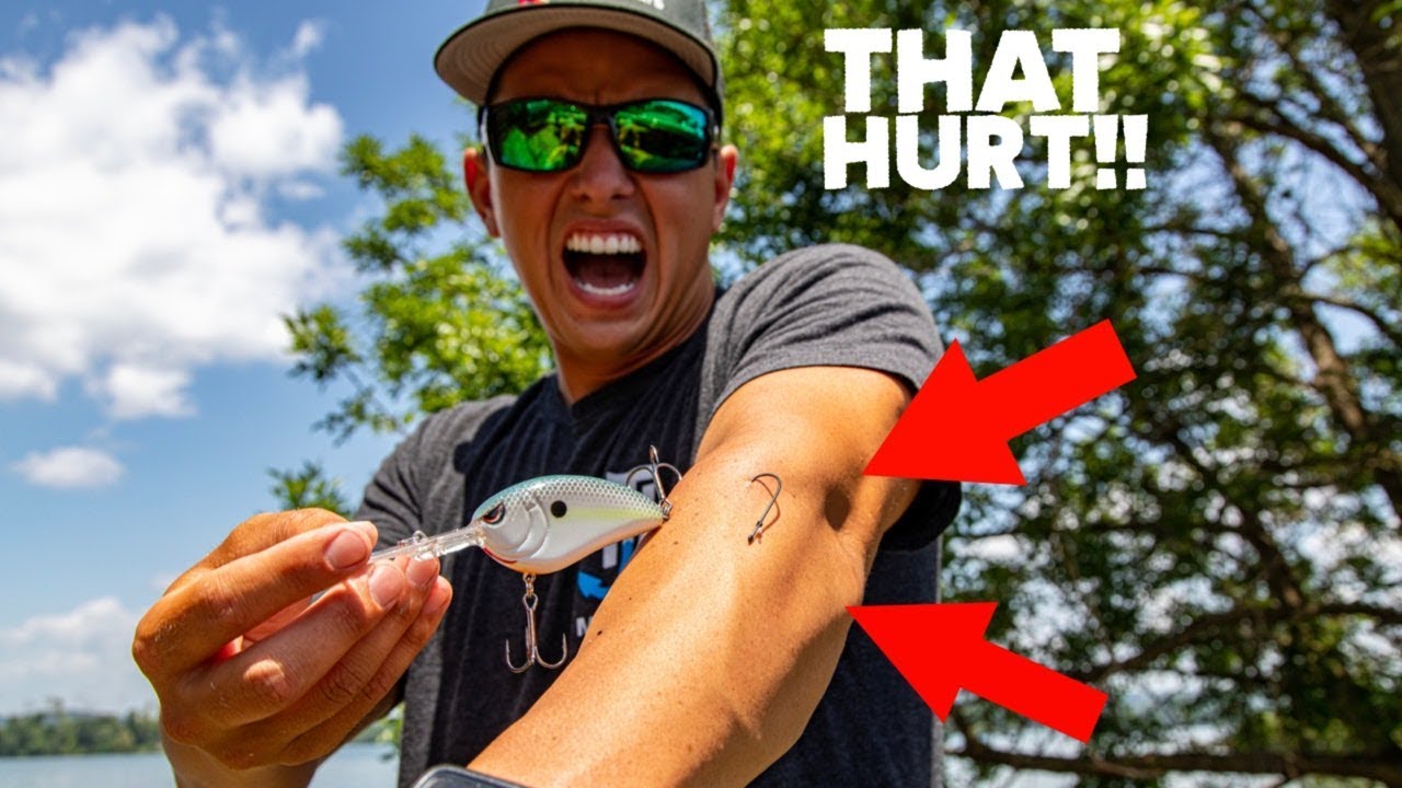 EASIEST HOOK REMOVAL TRICKI HOOKED MYSELF TO PROVE IT! ( How to remove a  fish hook ) 