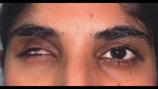 Life like prosthetic eye| Artificial eye movements | Dr Jibran